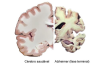 Alzheimer's :