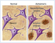 Alzheimeri yavaslatabilecek ilac